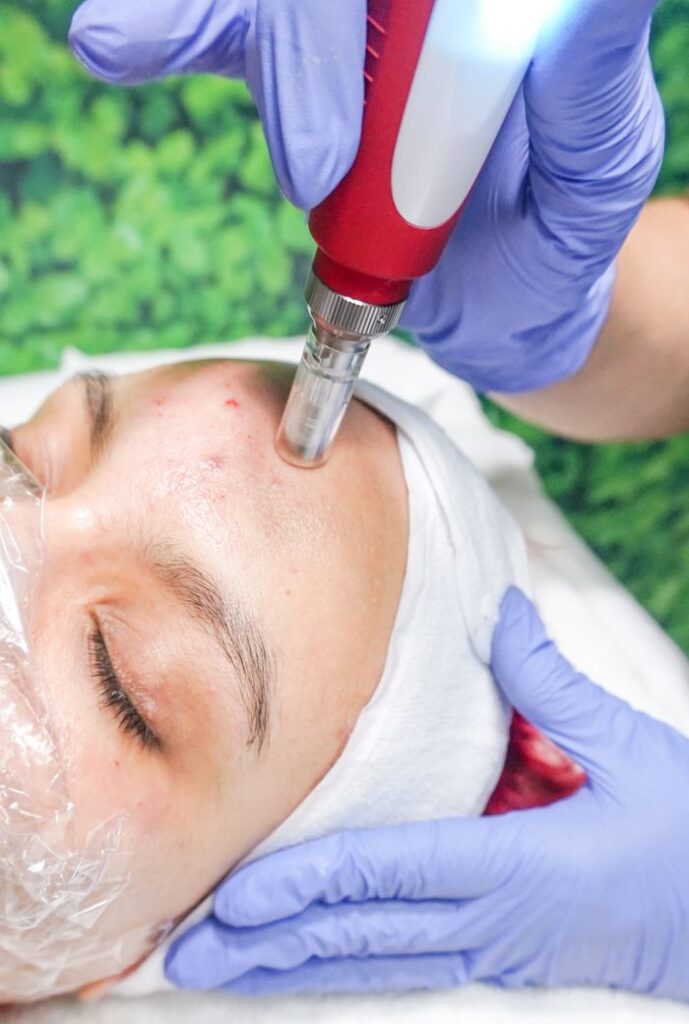 A woman receiving a professional microdermabrasion procedure for skincare improvement.
